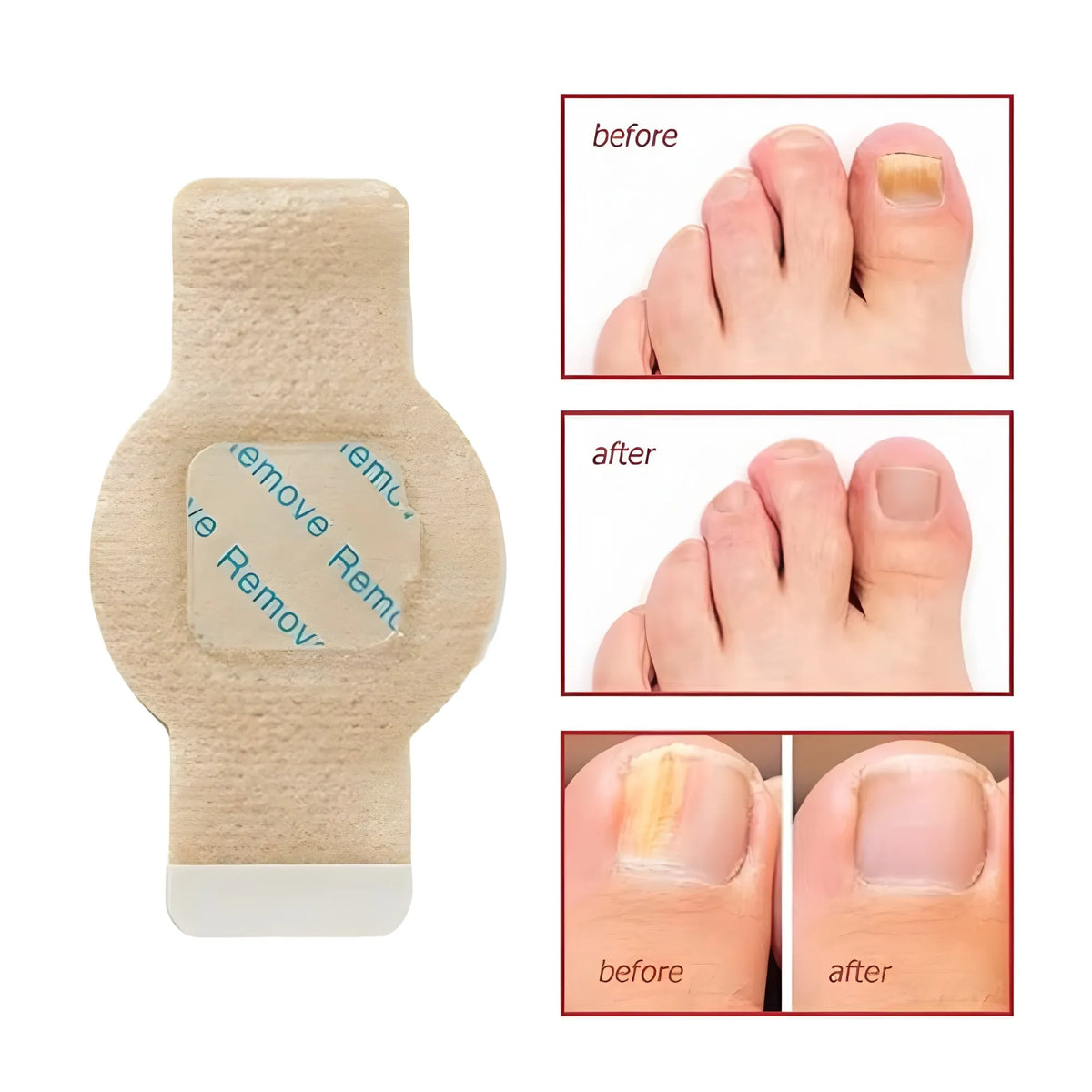 Fungal Nail Patches (Yellow)